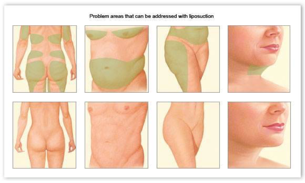 how liposuction works