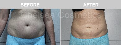 liposuction before and after